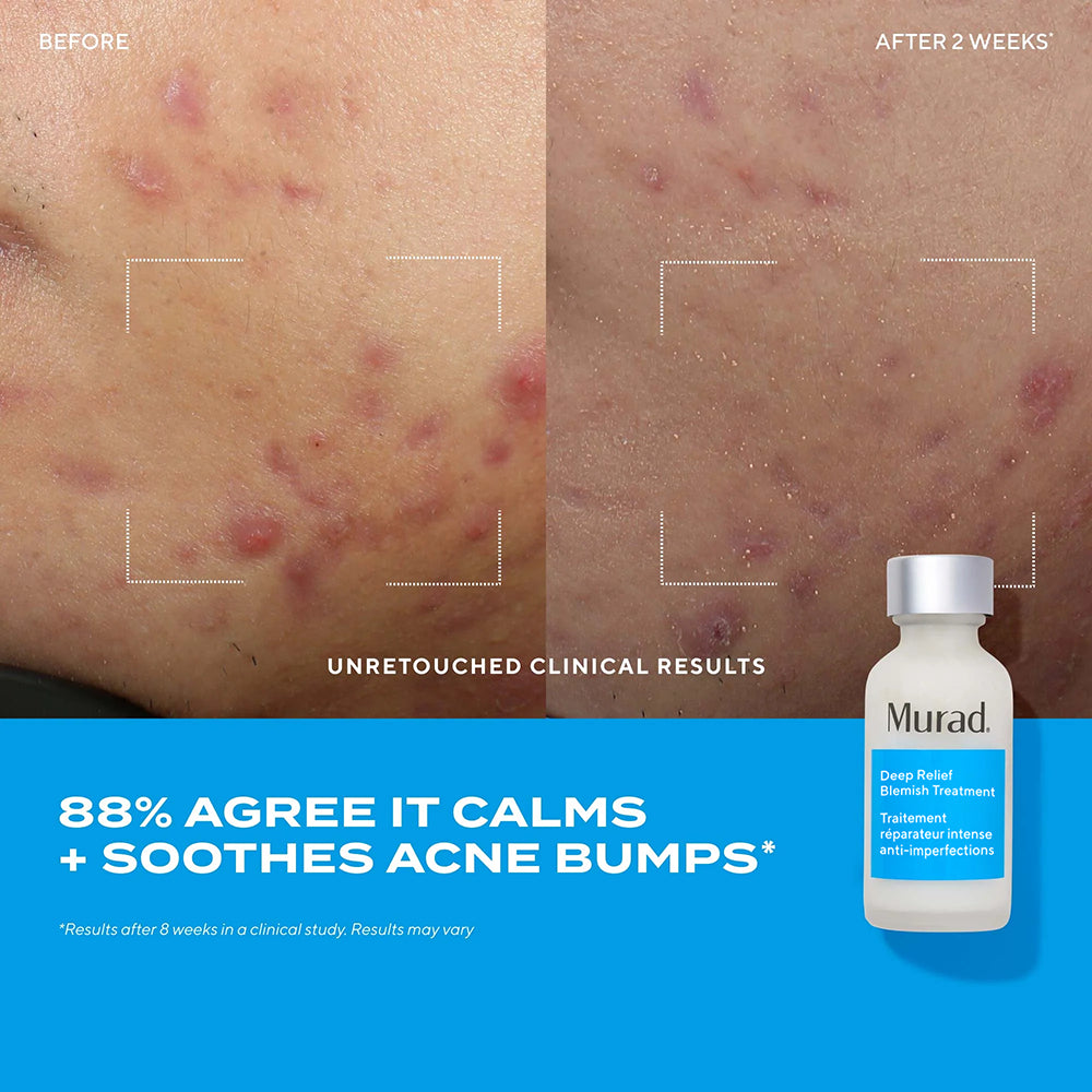 Deep Relief Blemish Treatment