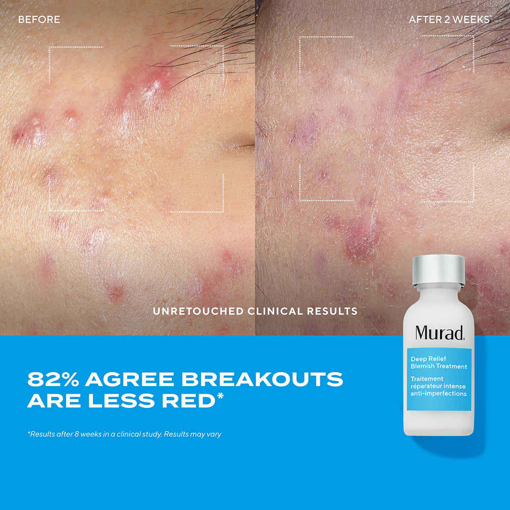 Deep Relief Blemish Treatment