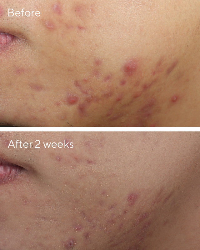 Deep Relief Blemish Treatment