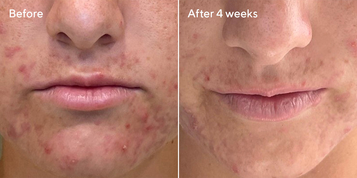 Deep Relief Acne Treatment B&A 4