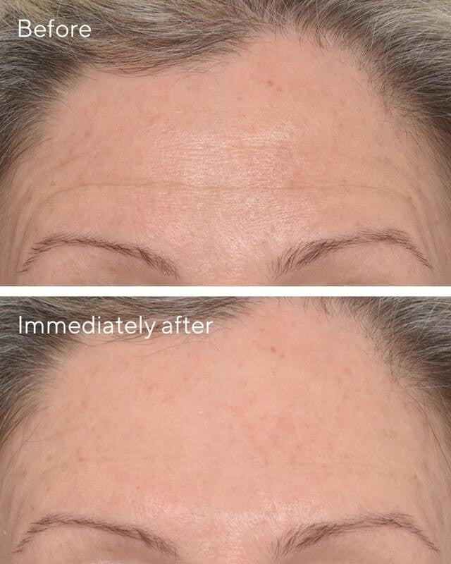 Targeted Wrinkle Corrector